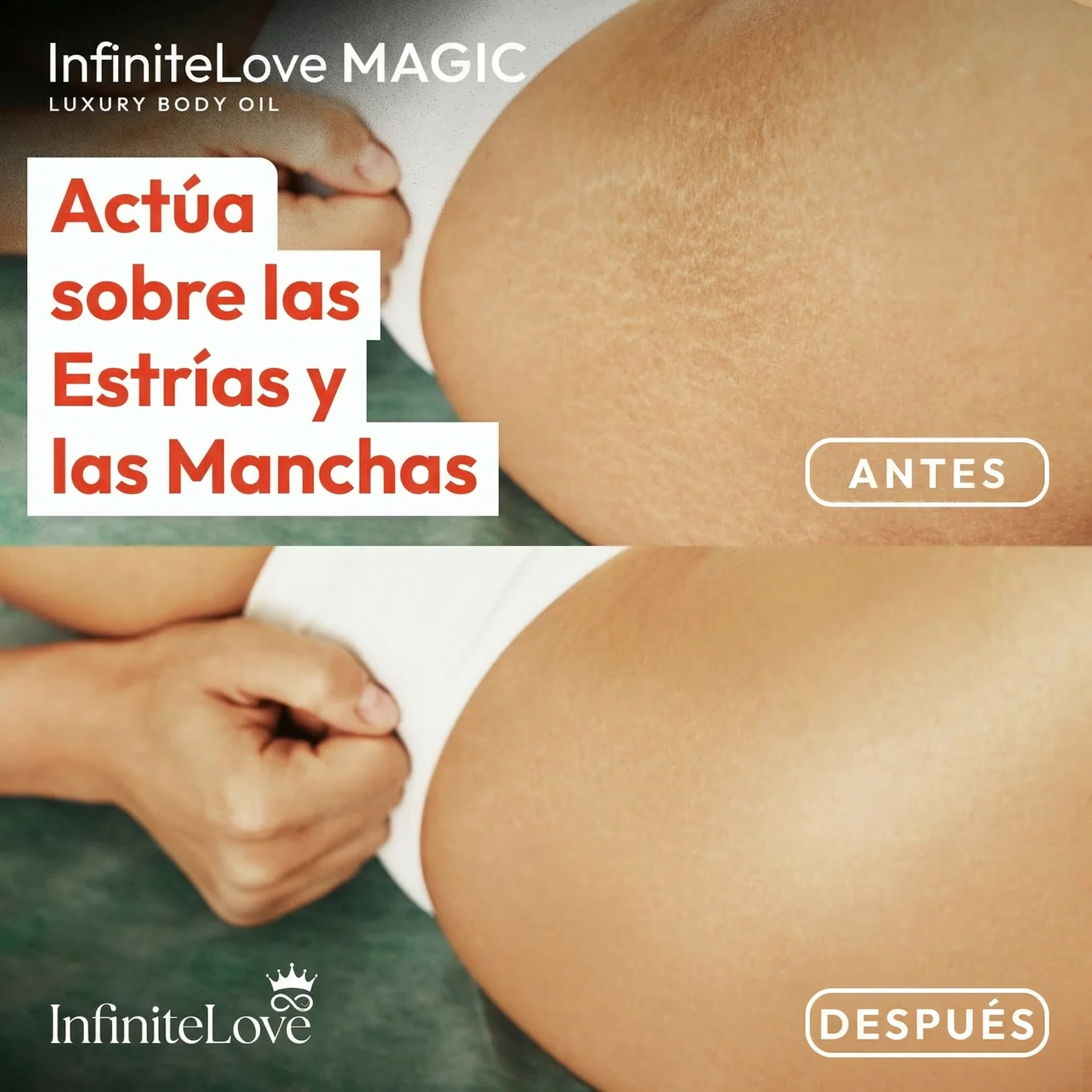 Aceite Corporal ElasticSkin™ – Estrías, Manchas y Piel Firme - Image 2