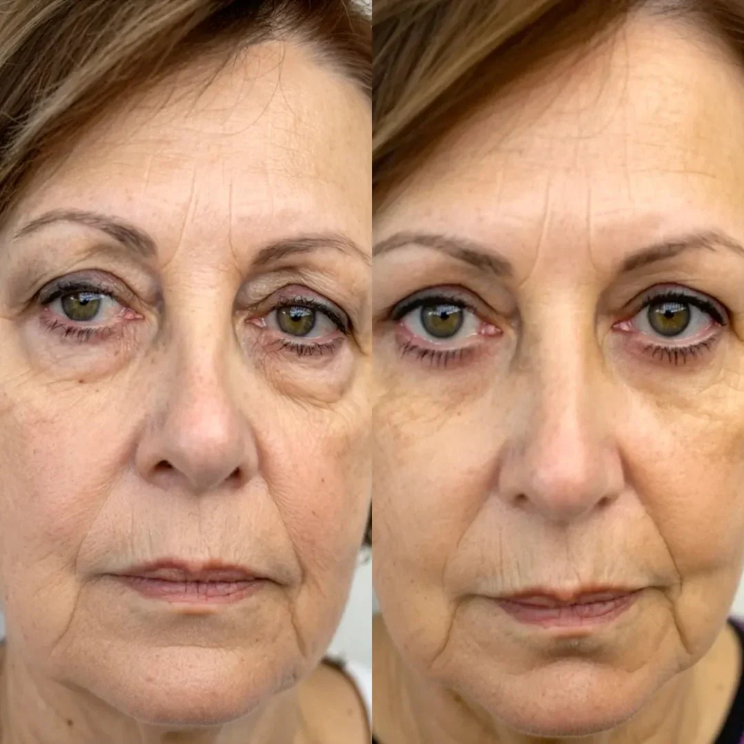 RevitaOjos - Dispositivo Antiedad de Luz Roja y EMS para Eliminar Bolsas, Ojeras y Hinchazón - Image 3